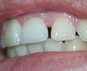 Diastema