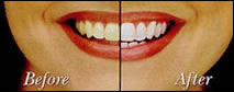 whitening